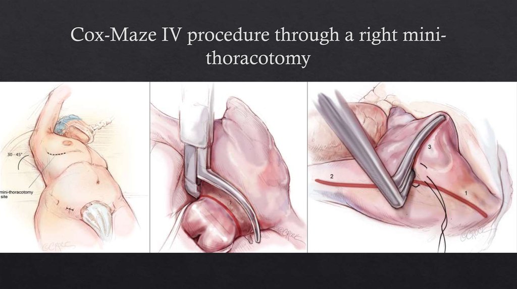 Cox-Maze IV procedure through a right mini-thoracotomy