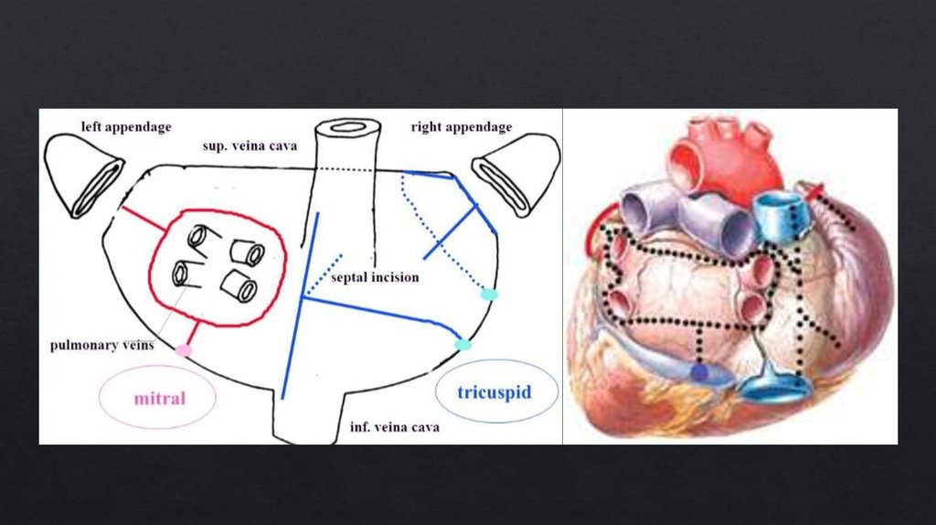 Факторы риска аритмии. Операции рча при фибрилляции предсердий. Фибрилляция предсердий на экг признаки. Операция при фибрилляции предсердий. Операция при фибрилляции предсердий.