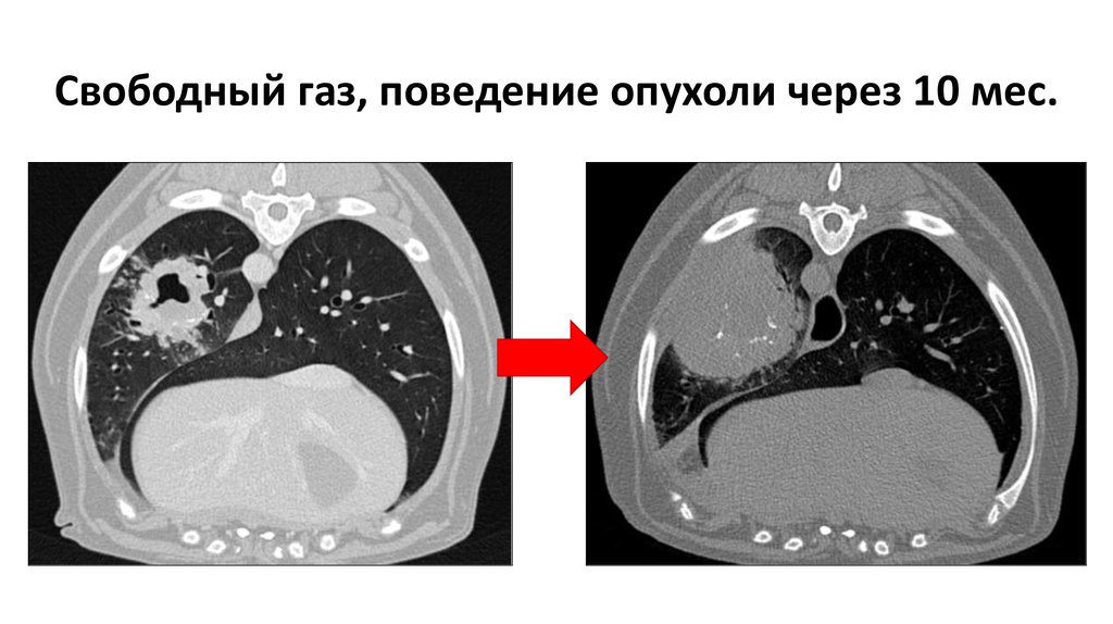 Свободный газ, поведение опухоли через 10 мес.