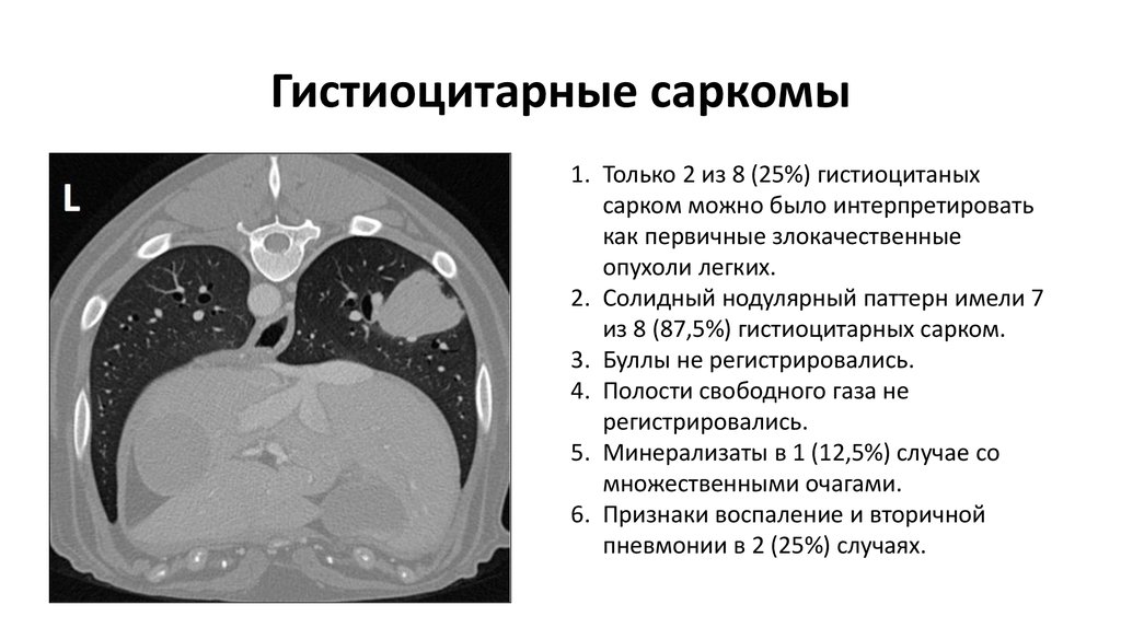 Гистиоцитарные саркомы
