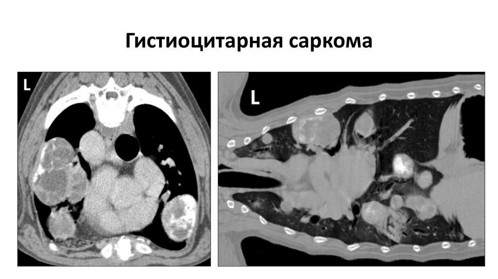 Саркома кт. Злокачественная гистиоцитарная опухоль. Гистиоцитарная саркома цитология.