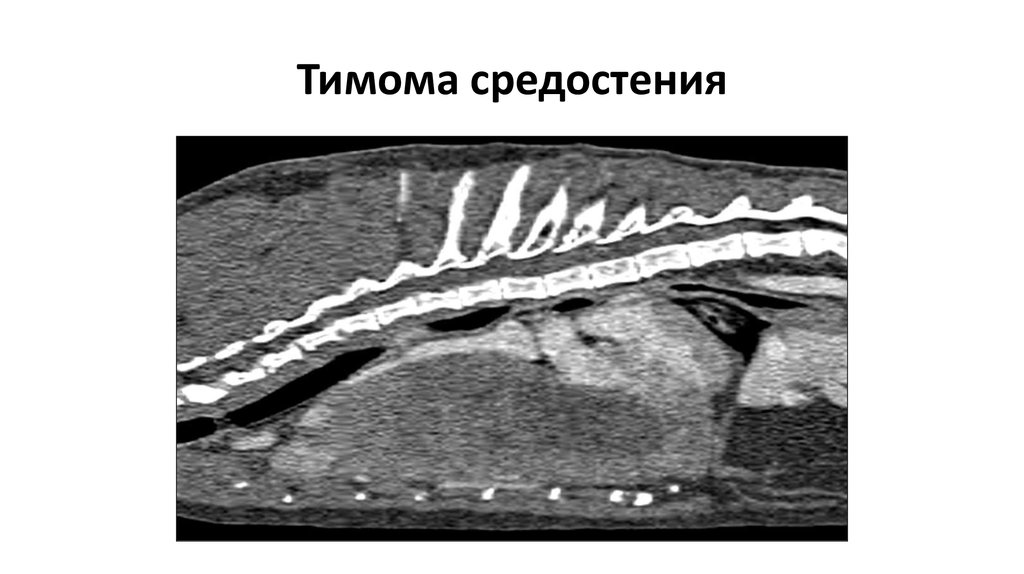 Тимома. Тимома средостения гистология. Тимома рецидив. Тимома средостения мкб.