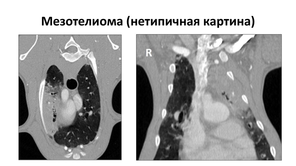 Мезотелиома плевры кт картина