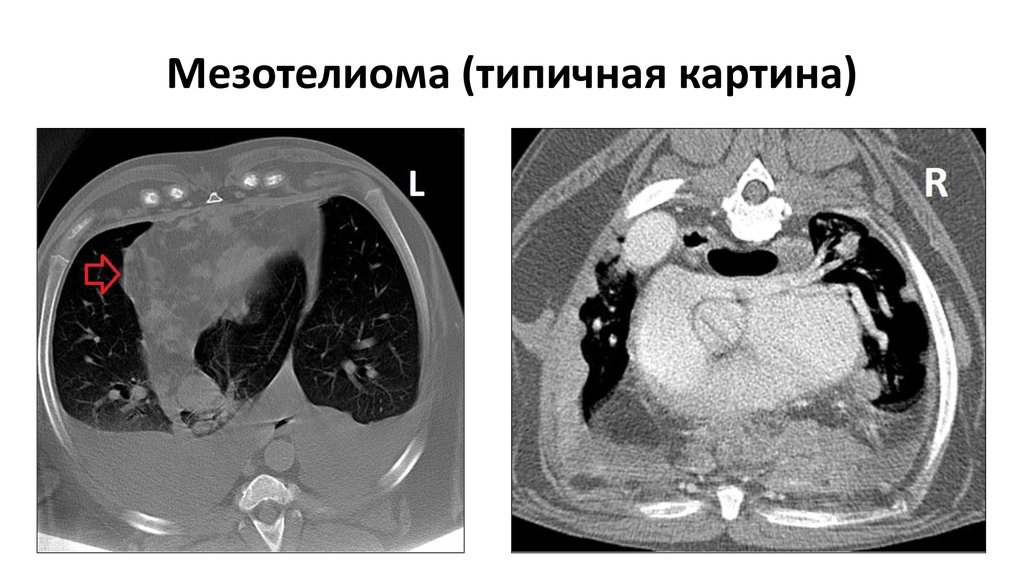 Мезотелиома плевры кт картина