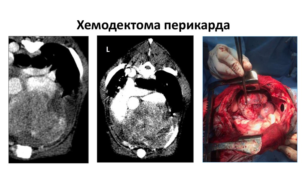 Хемодектома перикарда