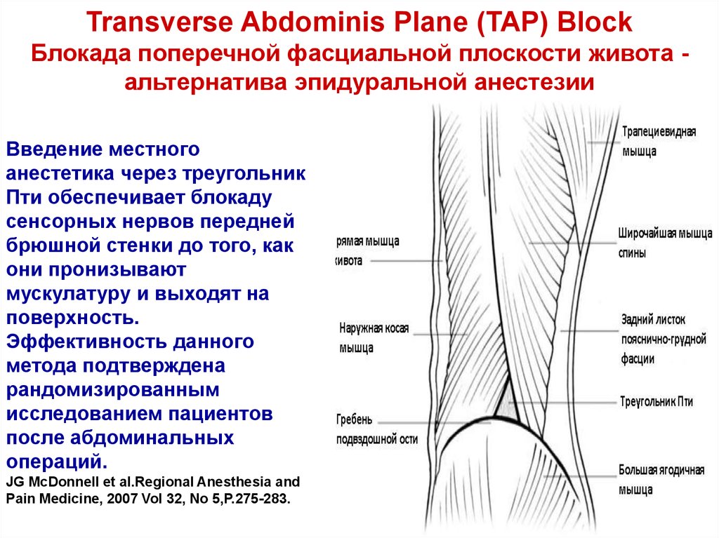 Блокада мышц. Tap блок в анестезиологии. Tab блок в анестезиологии. Блокада поперечного пространства живота. Таб блокада в анестезиологии.