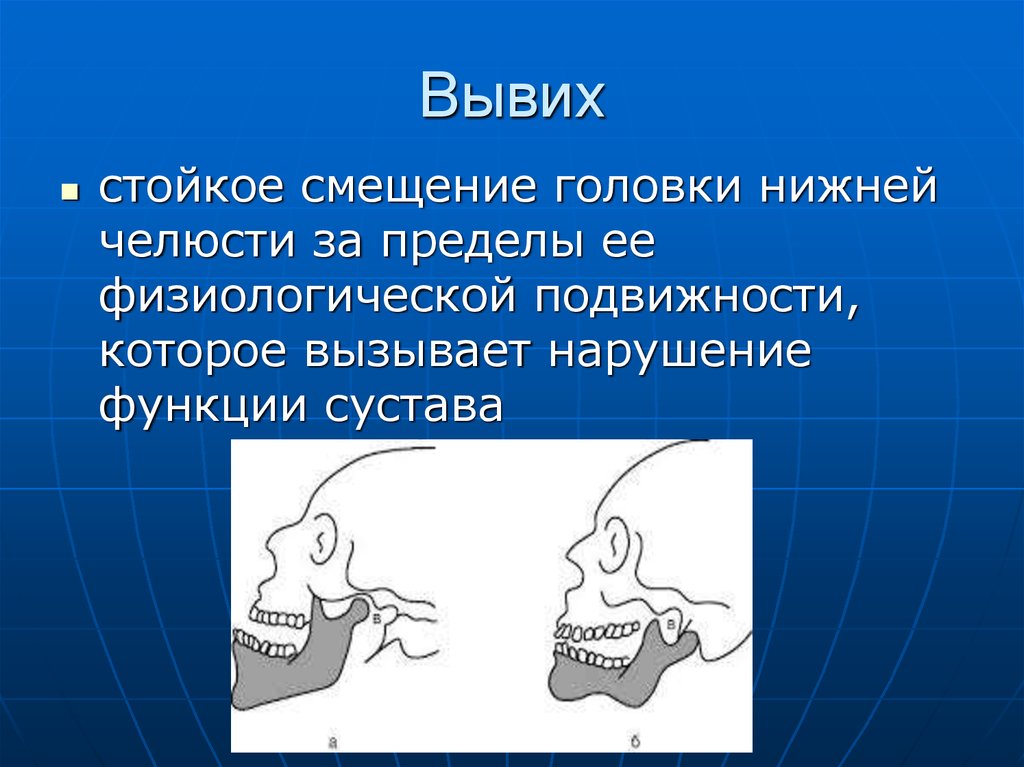 Вывих нижней челюсти. Смещение челюсти нижней челюсти. Смещение головок нижней челюсти. Нижняя челюсть смещена. Смещение суставной головки нижней челюсти.