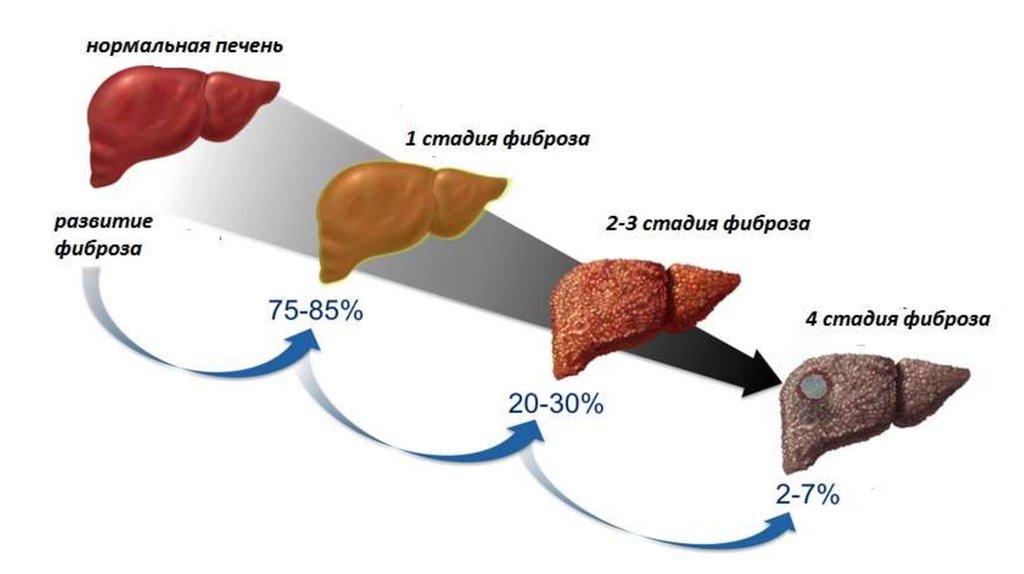 Гепатит с фиброз 2