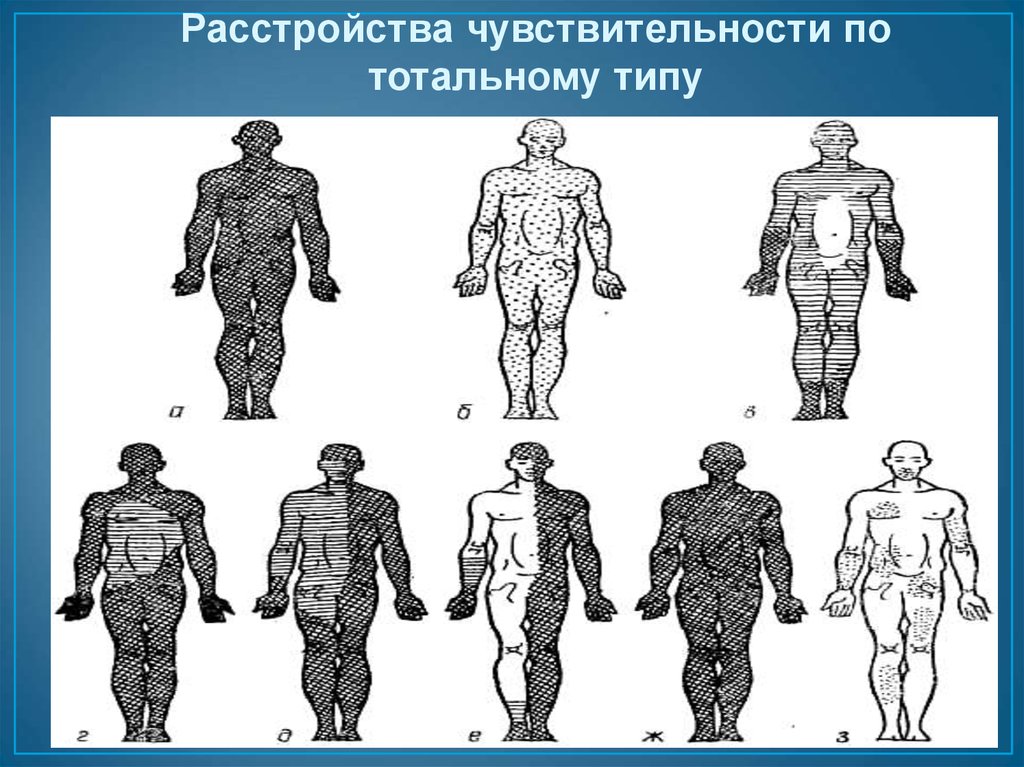 Типы поражения чувствительности. Расстройства чувствительности. Типы расстройств чувствительности. Типы нарушения чувствительности. Типы нарушения чувствительности по типу.