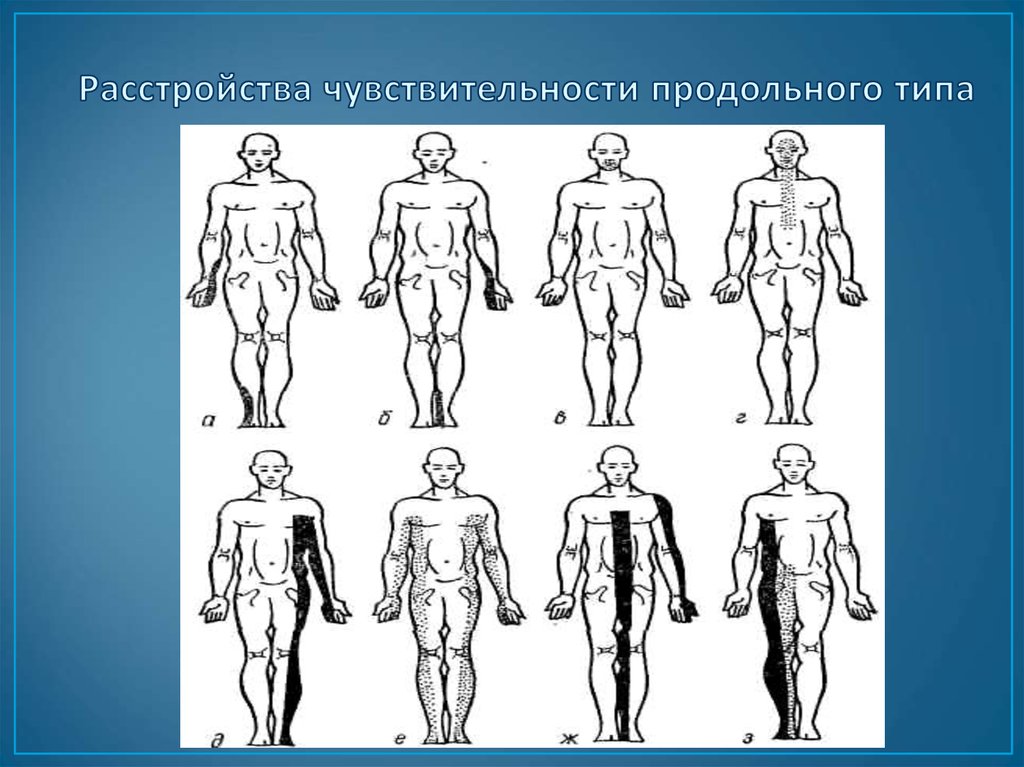 Синдромы нарушения чувствительности. Типы нарушения чувствительности. Корешковый Тип расстройства чувствительности. Типы чувствительности неврология. Сегментарный Тип расстройства чувствительности.