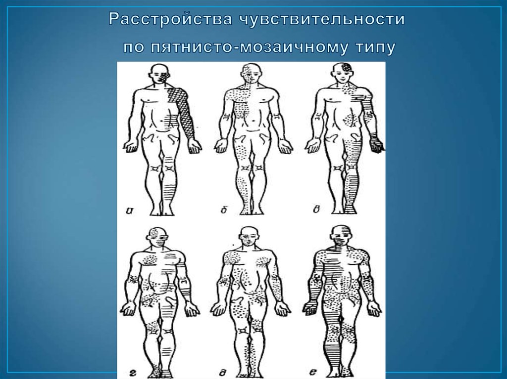 Нарушение чувствительности. Полиневритический Тип расстройства чувствительности. Расстройство чувствительности по мозаичному типу. Мозаичное нарушение чувствительности. Мозаичный Тип расстройства чувствительности.