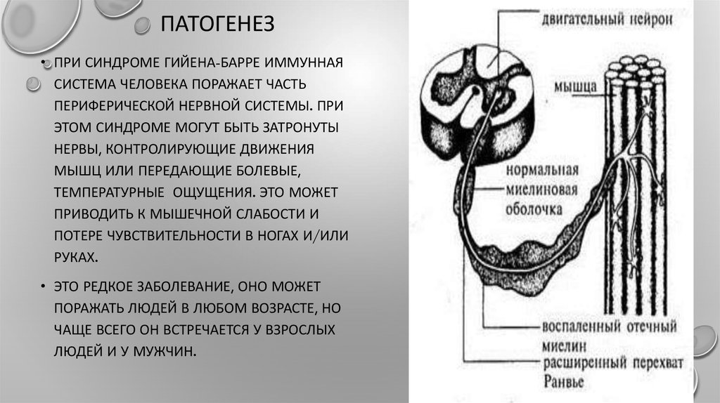 Синдром гийена барре презентация