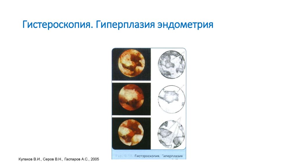 Гистероскопия эндометрия отзывы