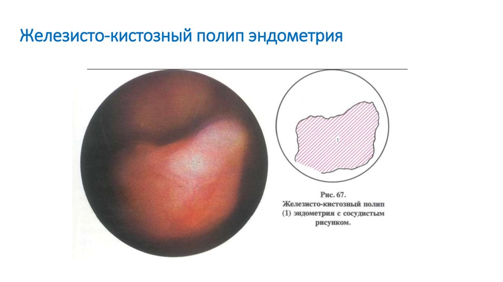 Выраженный сосудистый рисунок эндометрия