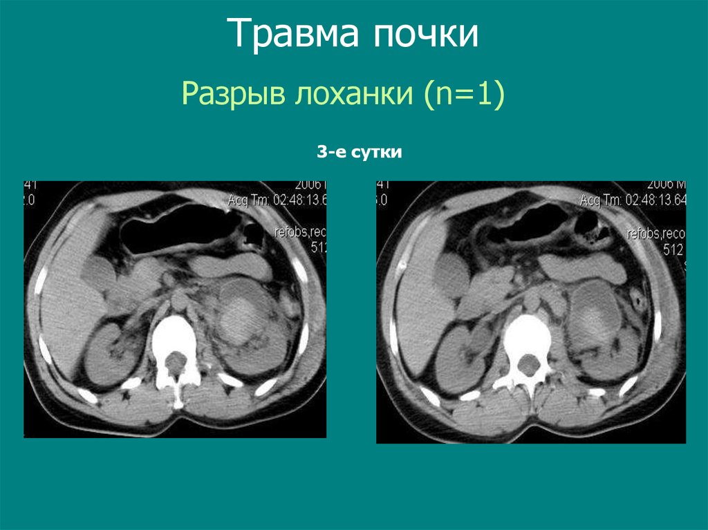 Травма почки