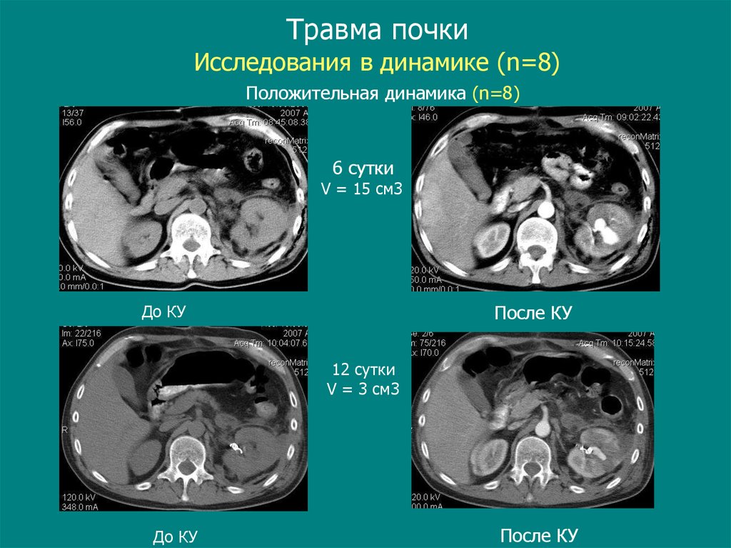 Травма почки