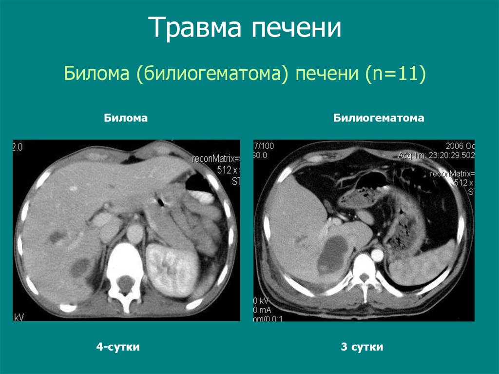 Травмы печени презентация