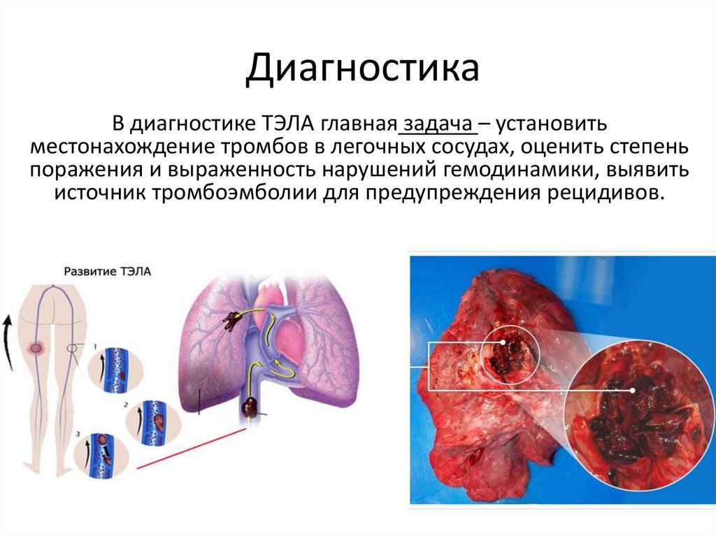 Диагностика ТЭЛА - презентация онлайн