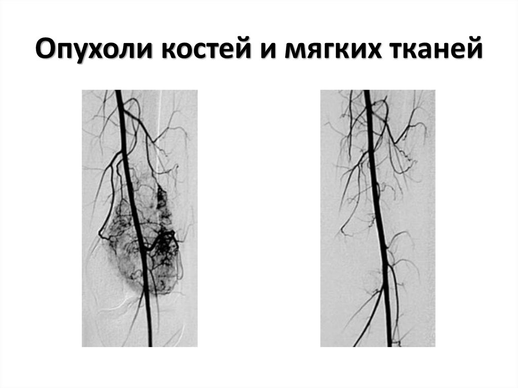 Опухоли мягких тканей презентация