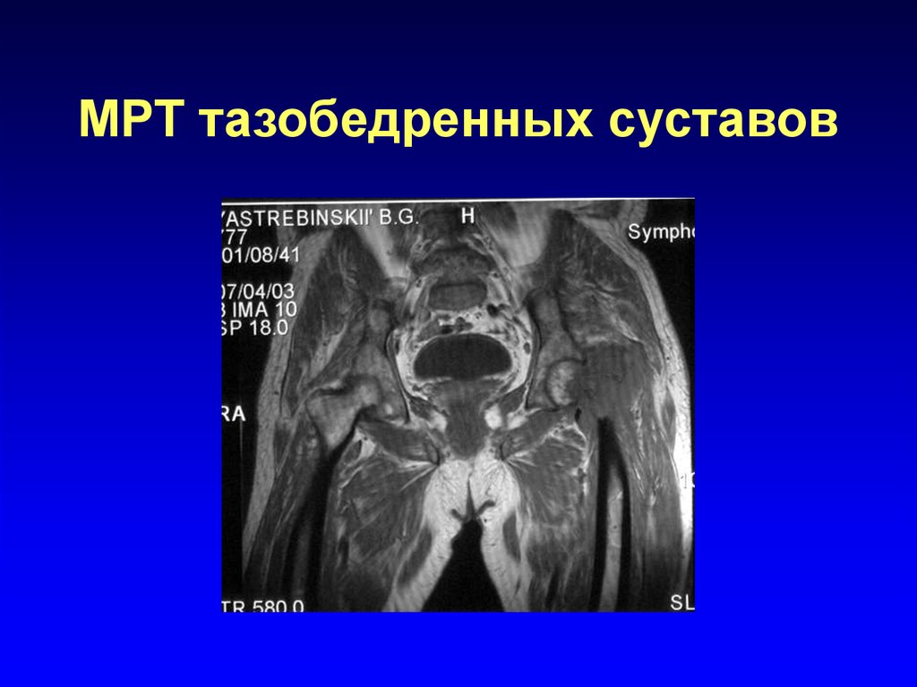 Как проводится мрт тазобедренного сустава фото