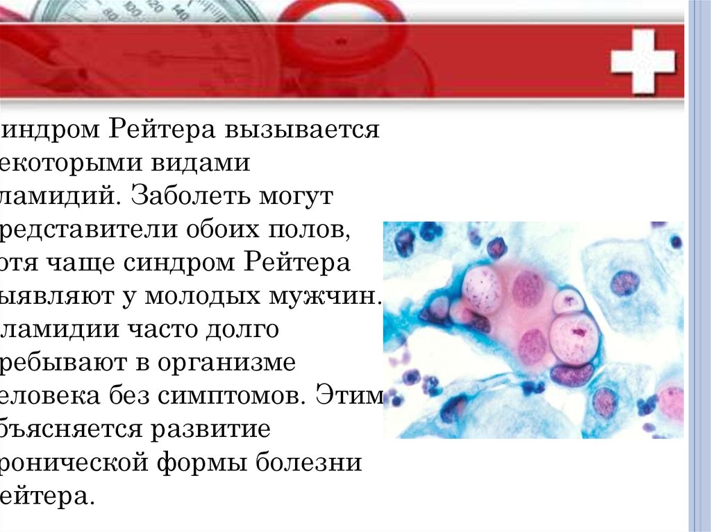 Синдром Рейтера. Особенности течения у офтальмологических больных ...