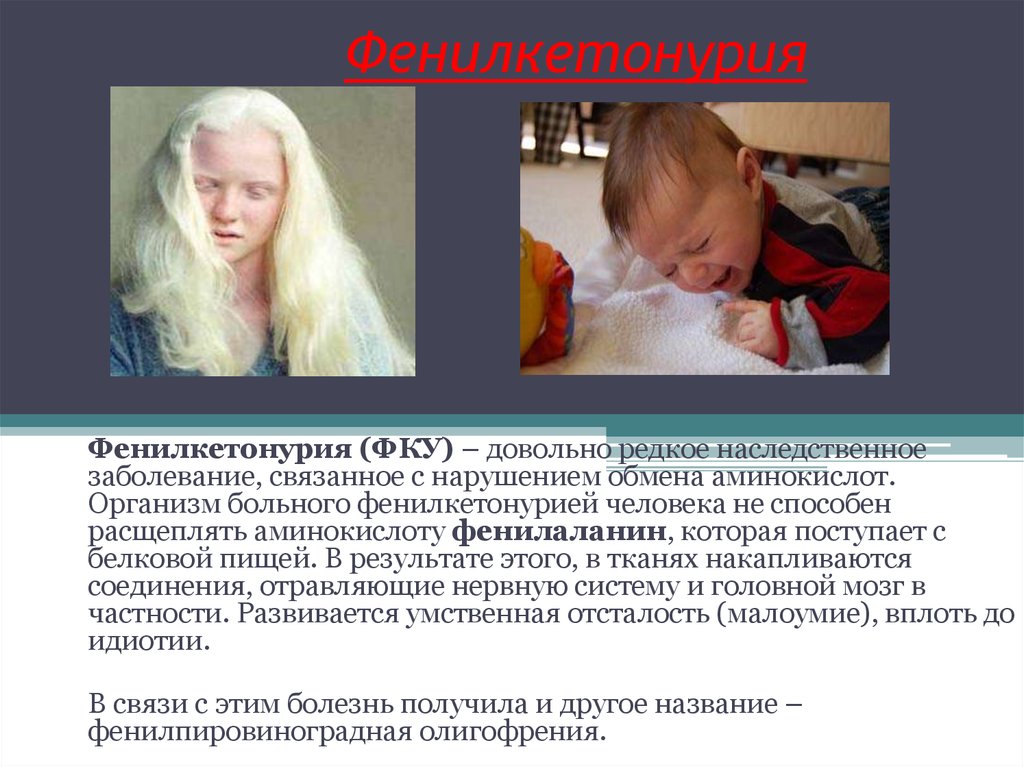 Фенилкетонурия генотип. Фенилкетонурия и альбинизм. Фенилкетонурия это генное заболевание. Фенилкетонурия аутосомно-рецессивный. Фенилкетонурия (фенилпировиноградная олигофрения).