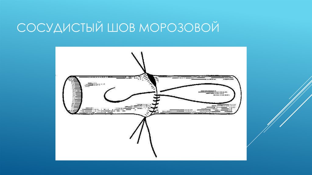 Сосудистый шов история