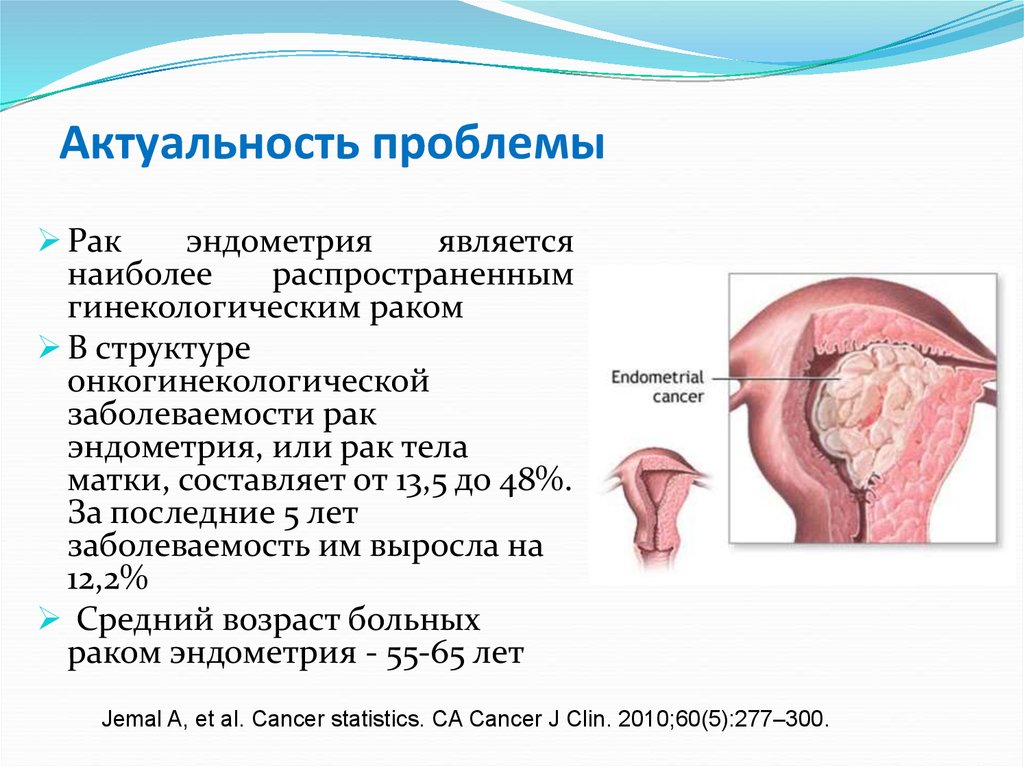 Новообразования эндометрия. Опухоль эндометрия матки. Опухоли тела матки классификация.