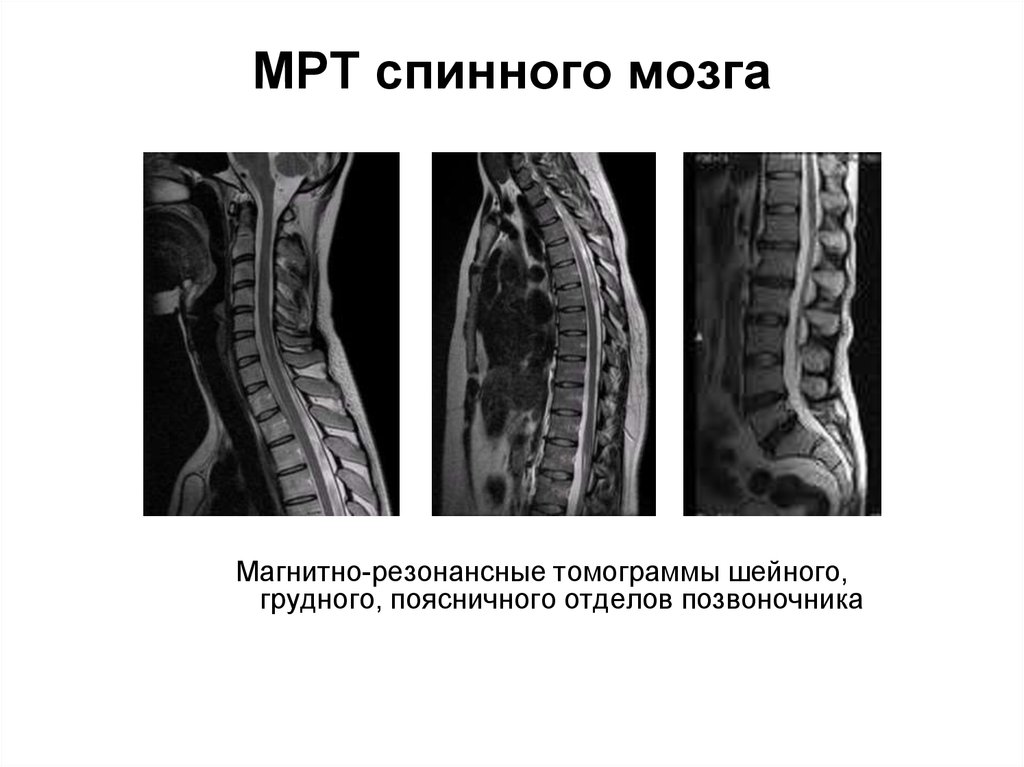 МРТ спинного мозга