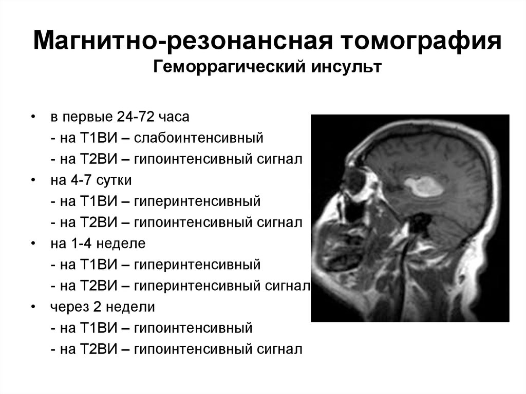 Магнитно-резонансная томография Геморрагический инсульт