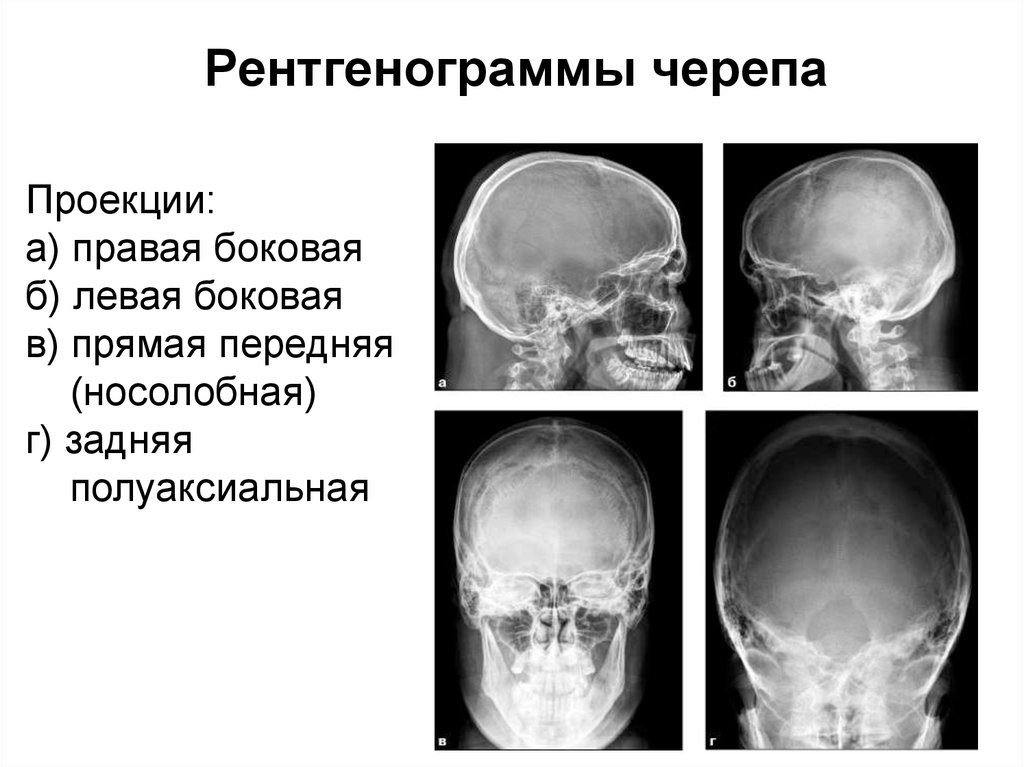 Рентгенограммы черепа