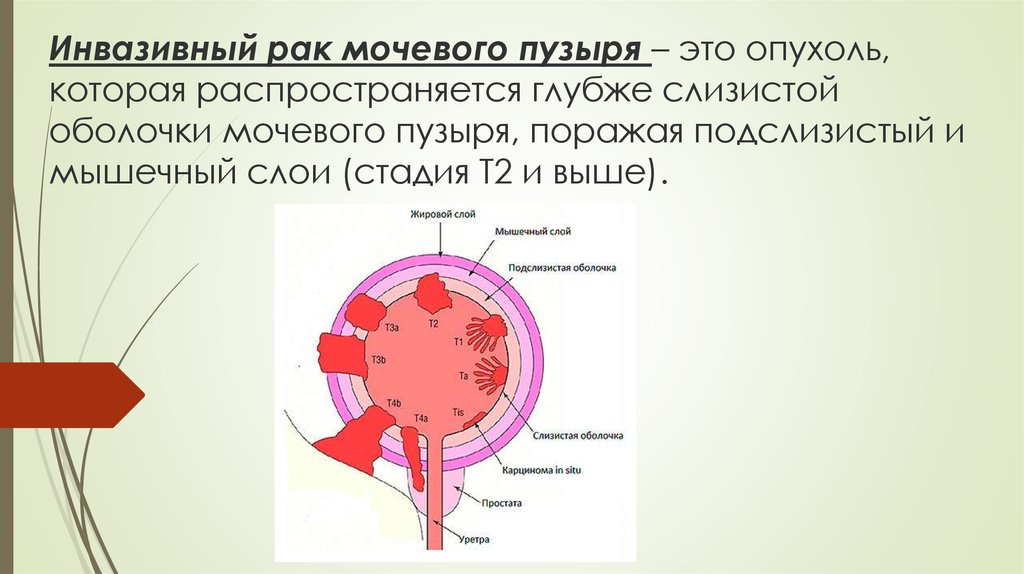 Рак мочевого пузыря фото