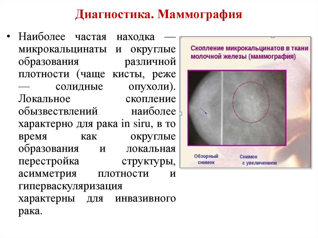 Маммография диагнозы. Диагноз маммографии. Диагноз при маммографии. Маммография диагноз норма. М2 маммография что это.