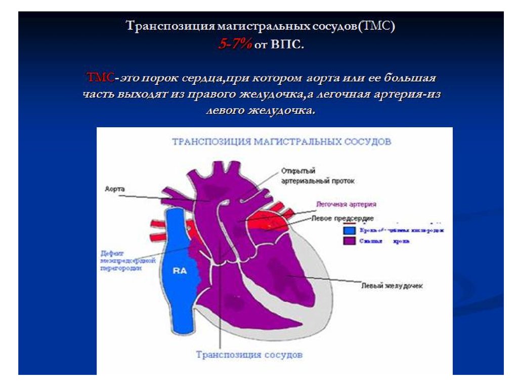 Магистральные сосуды это. Врожденный порок сердца транспозиция магистральных артерий. Порок транспозиция магистральных сосудов. ВПС транспозиция магистральных сосудов. ТМС порок сердца гемодинамика.