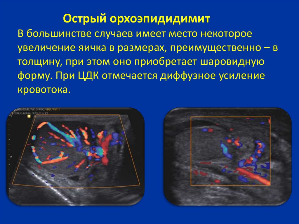 В большинстве случаев имеет. Острый орхоэпидидимит. Острый двухсторонний орхоэпидидимит. Острый орхоэпидидимит этиология. Операции при остром орхоэпидидимите.