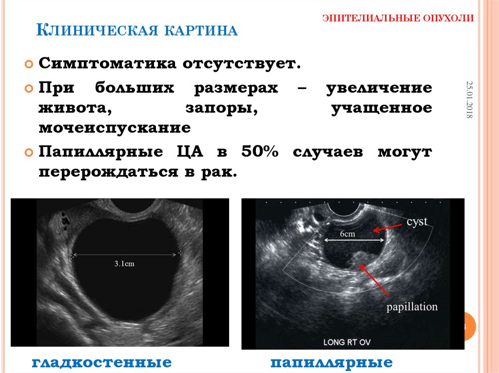 Варианты осложнений при доброкачественных опухолях яичника дающие острую клиническую картину