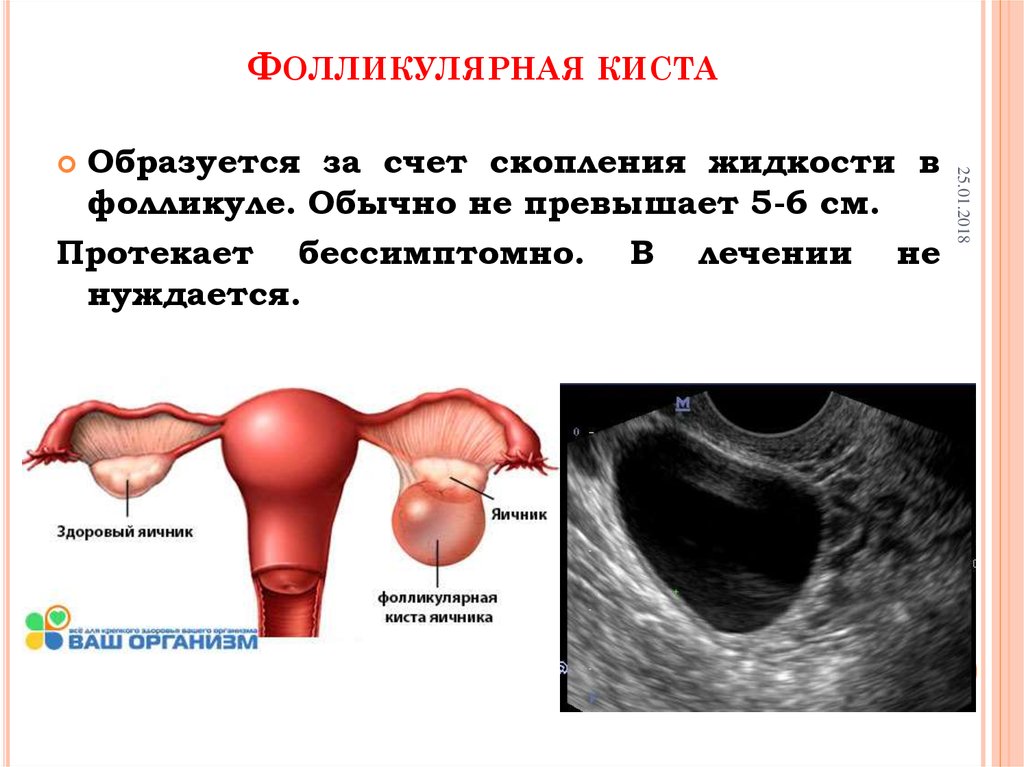 Что образуется в яичниках. Фолликулярная киста яичника на УЗИ симптомы. Киста левого яичника на УЗИ. Киста яичника на УЗИ 5см правого. Как выглядит функциональная киста яичника на УЗИ.