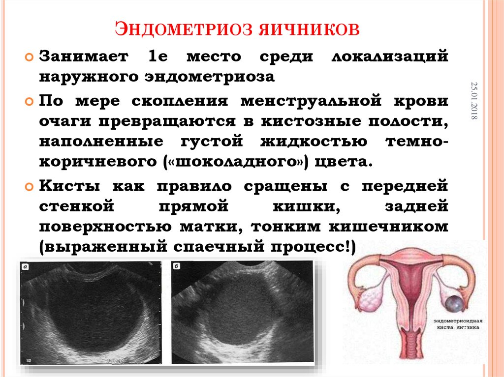 Эндомитоз у женщины. Эндометриоидной кисты. Эндометриоидные опухоли яичников.