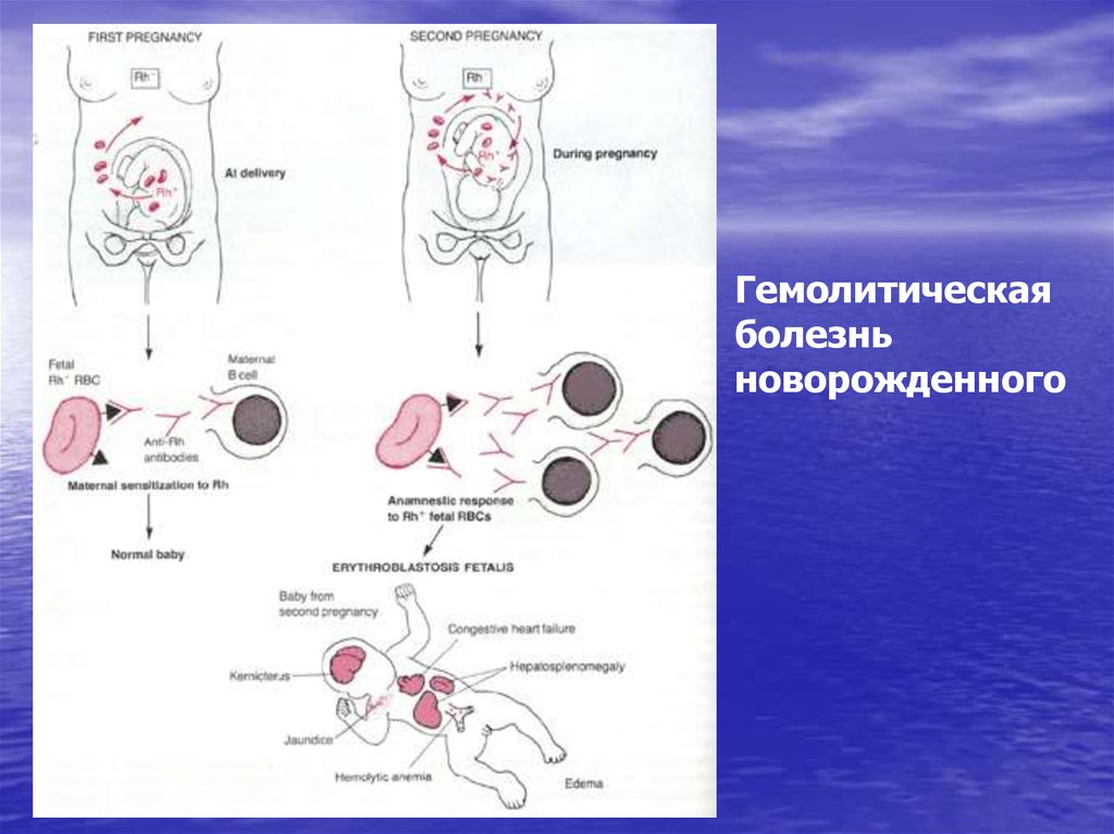 Анемия гемолитической болезни новорожденных. Схема патогенеза гемолитической болезни новорожденных. Гемолитическая болезнь плода иммунология. Гемолитическая болезнь новорожденных анемичная форма. «Клетка-мишень» при гемолитической болезни новорожденного:.