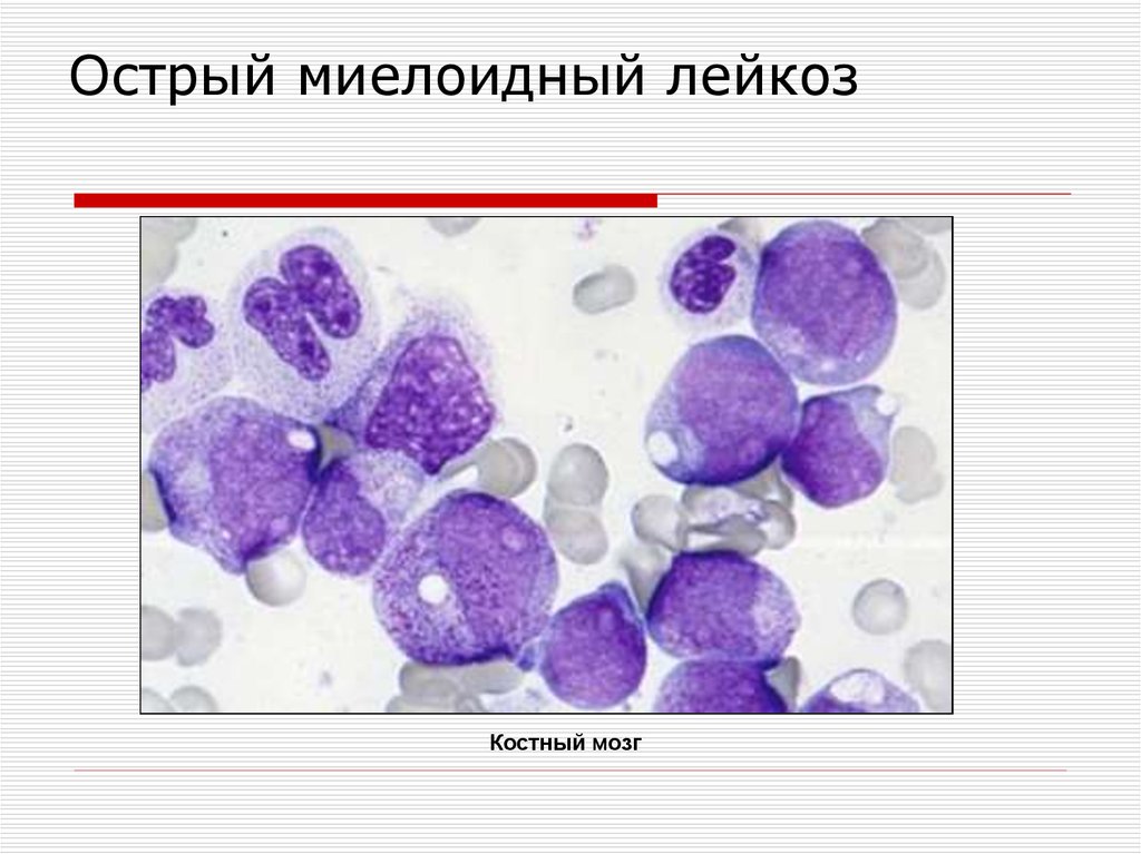 Острый лейкоз презентация