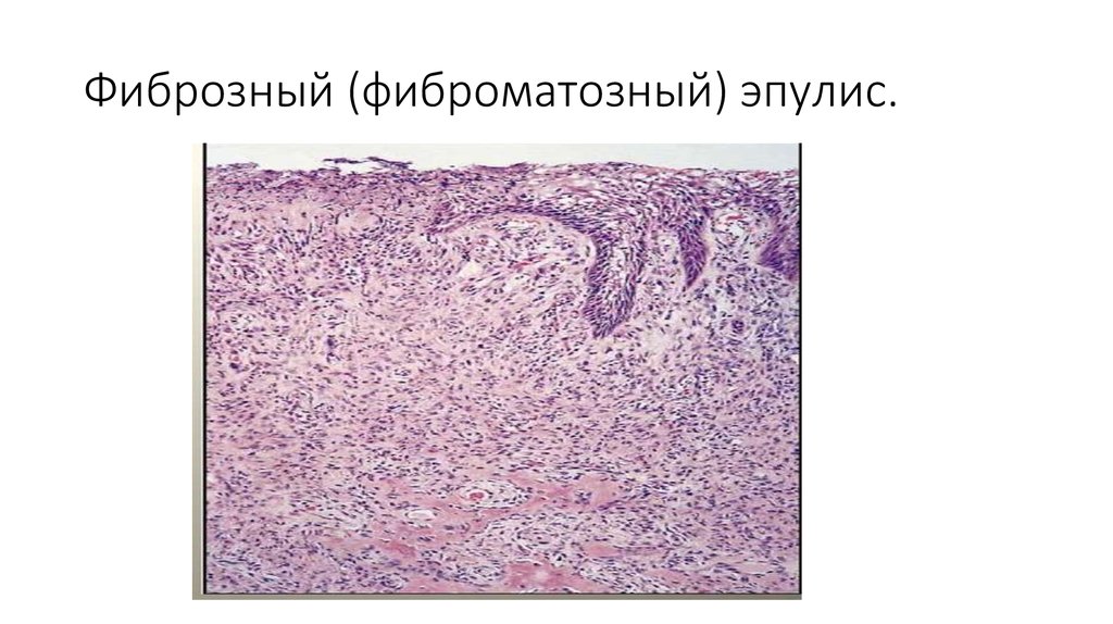 Клиническая картина периферической гигантоклеточной гранулемы характеризуется