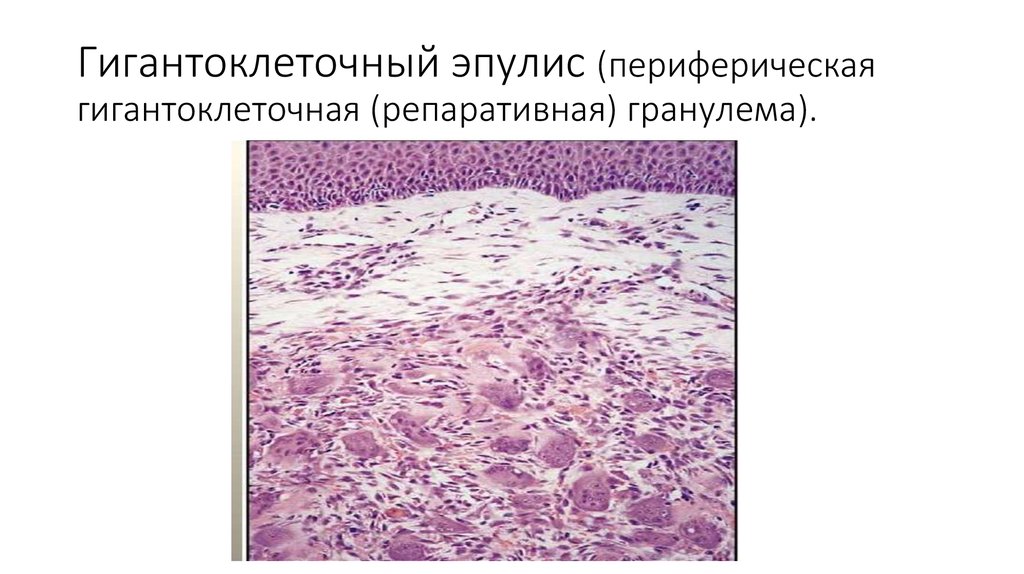 Клиническая картина периферической гигантоклеточной гранулемы характеризуется