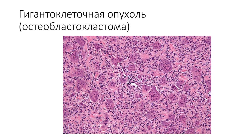 Для рентгенологической картины ячеистой формы гигантоклеточной опухоли характерно