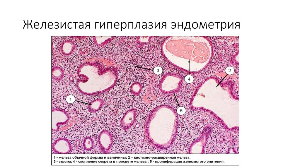 Сложная эндометрия. Гиперплазия эндометрия микропрепарат. Простая гиперплазия эндометрия микропрепарат. Железисто-кистозная гиперплазия эндометрия микропрепарат. Железистая гиперплазия слизистой оболочки матки.