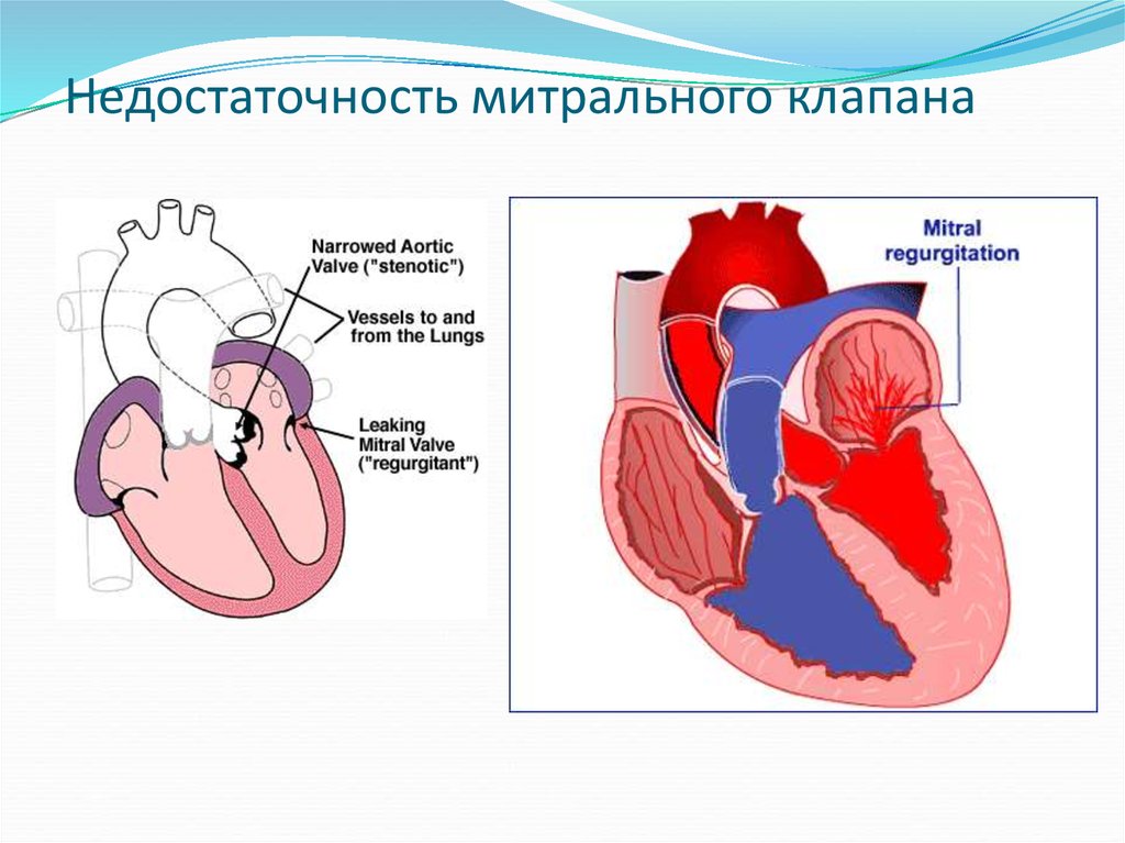 Сердечная недостаточность митрального клапана. Недостаточность двустворчатого (митрального) клапана. Митральный клапан двустворчатый. Митральная клапанная недостаточность. Пороки сердца недостаточность митрального клапана.