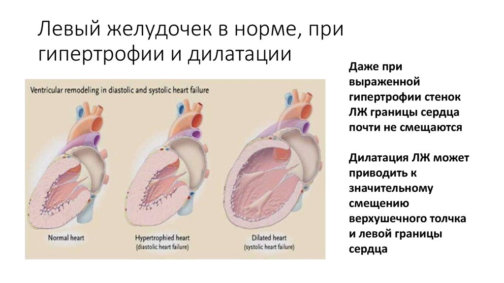 Желудочка сердца расширена. Дилятация полости левого желудочка. Гипертрофия левого желудочка сердца показатели. Дилатация желудочков сердца. Дилатация правого желудочка симптомы.