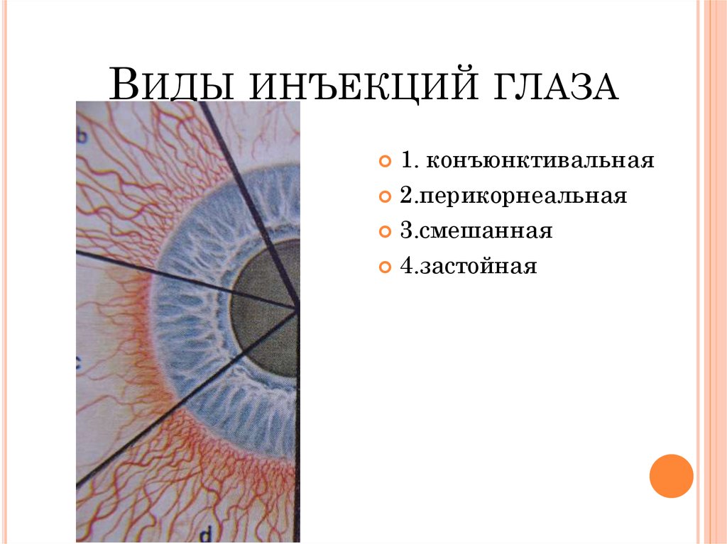 Виды инъекций. Перикорнеальная инъекция сосудов глаза. Перикорнеальная инъекция конъюнктивы. Перикорнеальная инъекция сосудов склеры. Смешанная инъекция сосудов конъюнктивы.