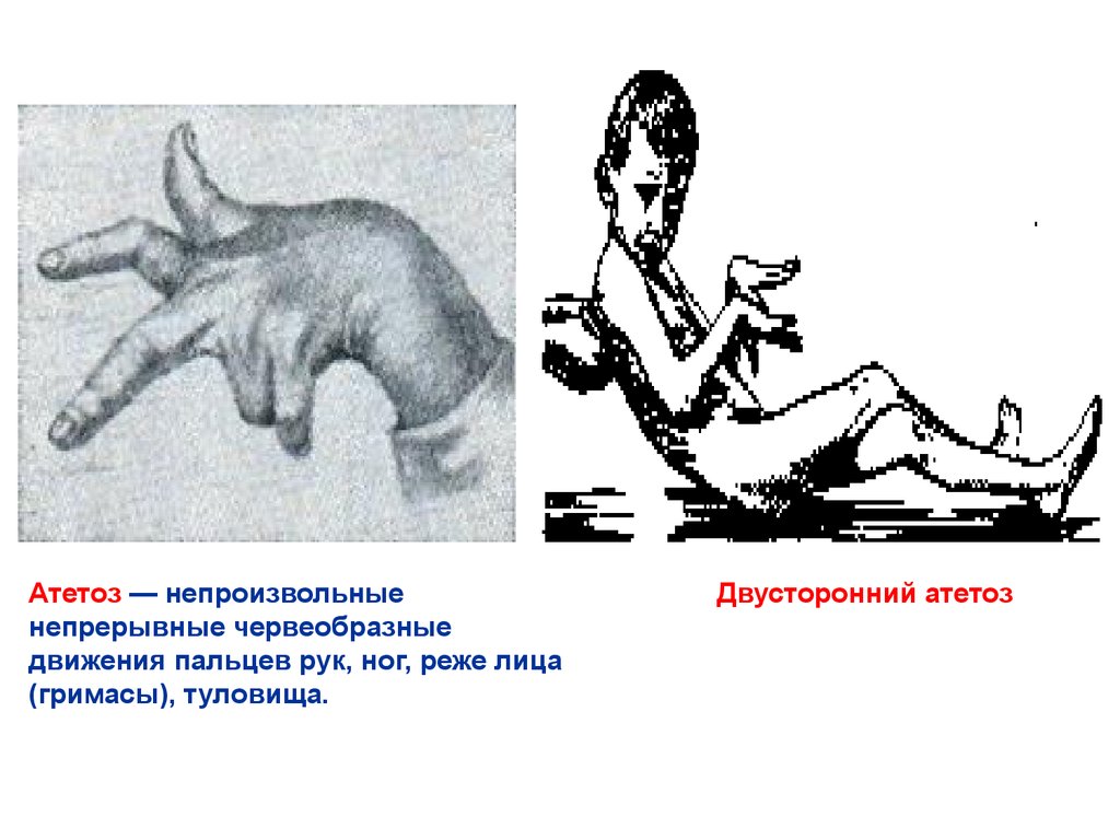 Непроизвольные движения. Атетоидный гиперкинез. Атетозоподобные движения пальцев рук.