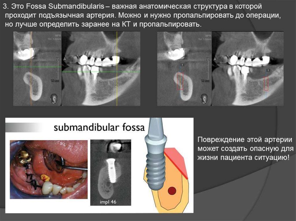 Анатомические предпосылки стоматологической имплантации презентация