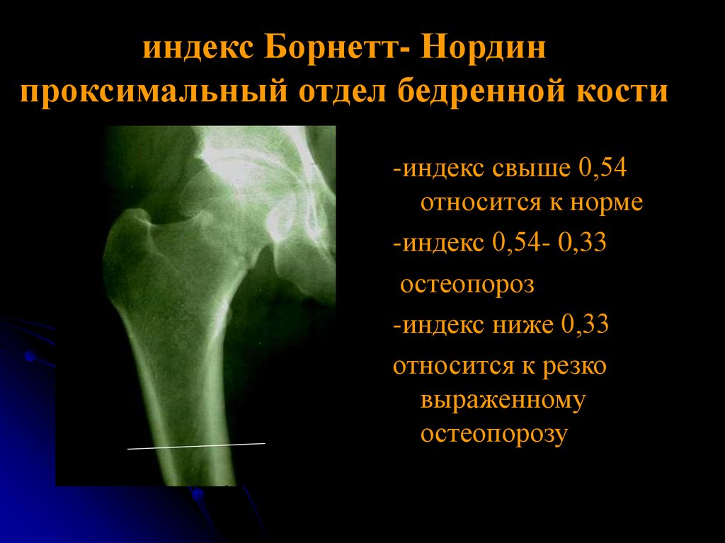 Бедренный отдел. Проксимальный отдел бедренной кости рентген. Проксимальный отдел левой бедренной кости. Проксимального отдела бедренной. Проксимальные отделы бедренных костей.